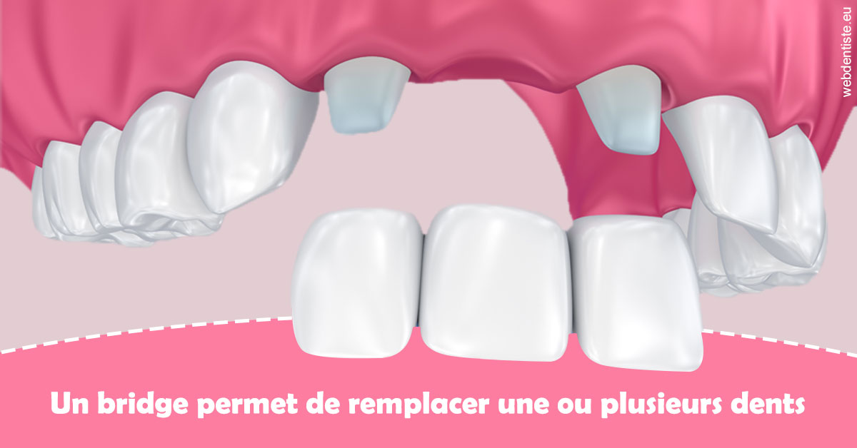 https://www.dentiste-saffar.fr/Bridge remplacer dents 2