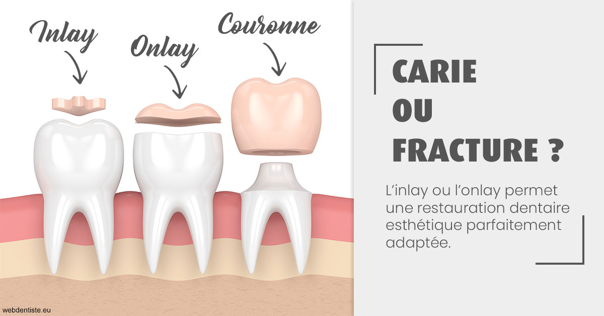 https://www.dentiste-saffar.fr/T2 2023 - Carie ou fracture 1