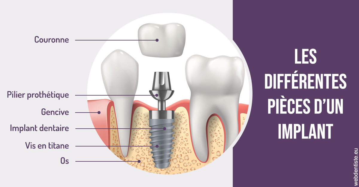https://www.dentiste-saffar.fr/Les différentes pièces d’un implant 2