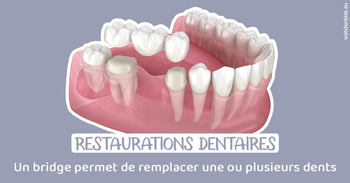 https://www.dentiste-saffar.fr/Bridge remplacer dents 1