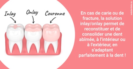 https://www.dentiste-saffar.fr/L'INLAY ou l'ONLAY 2