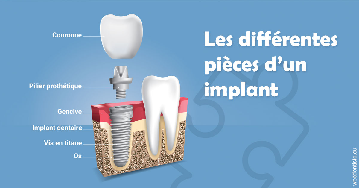 https://www.dentiste-saffar.fr/Les différentes pièces d’un implant 1