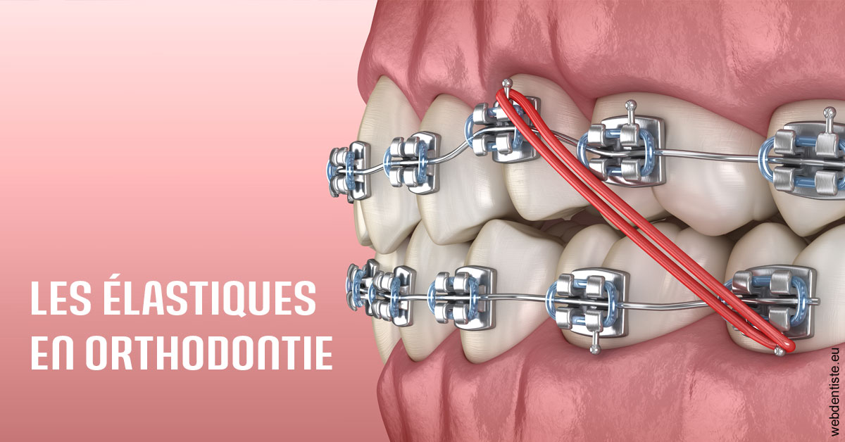 https://www.dentiste-saffar.fr/Elastiques orthodontie 2